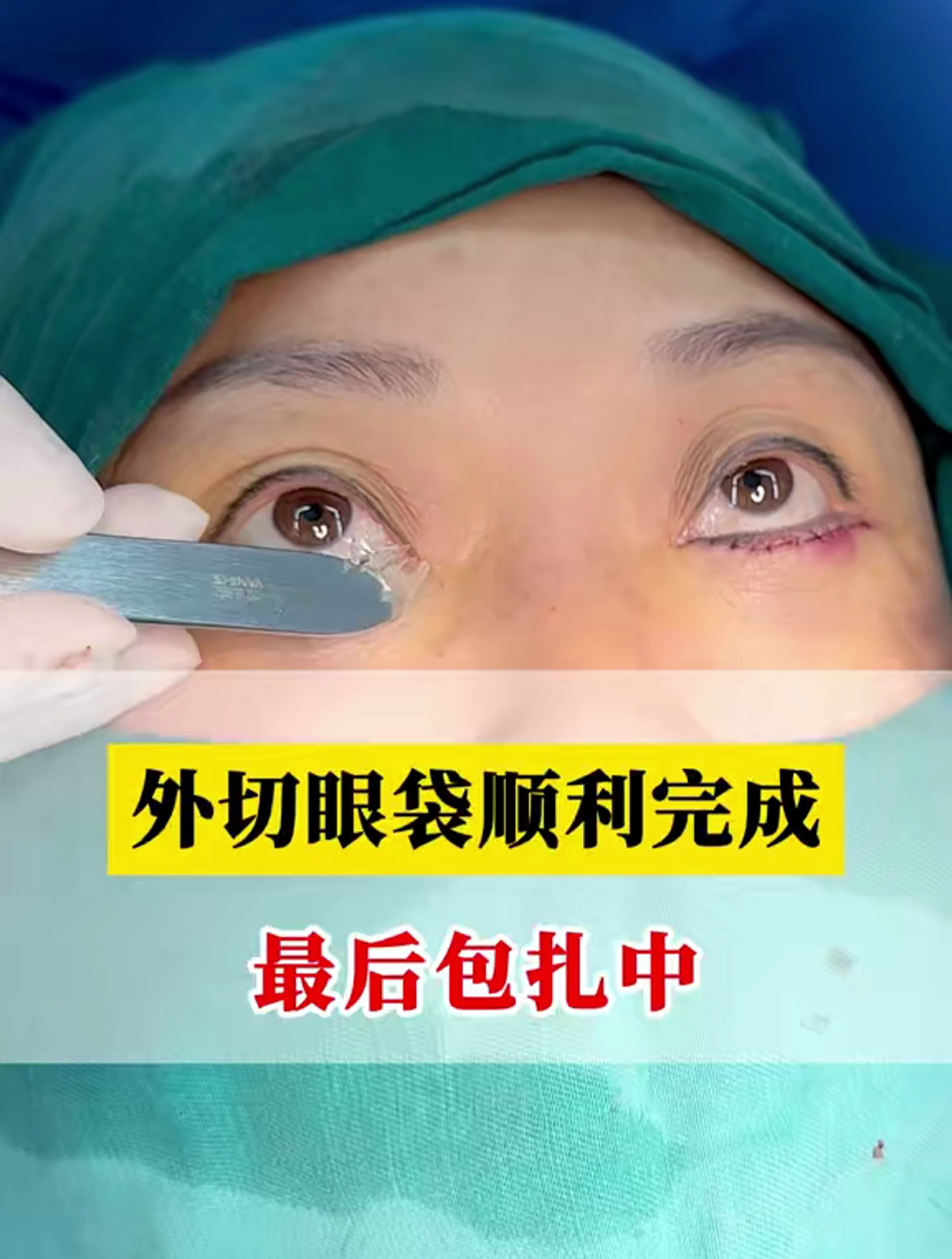 眼袋手术最后包扎中,你知道最后涂的什么吗?