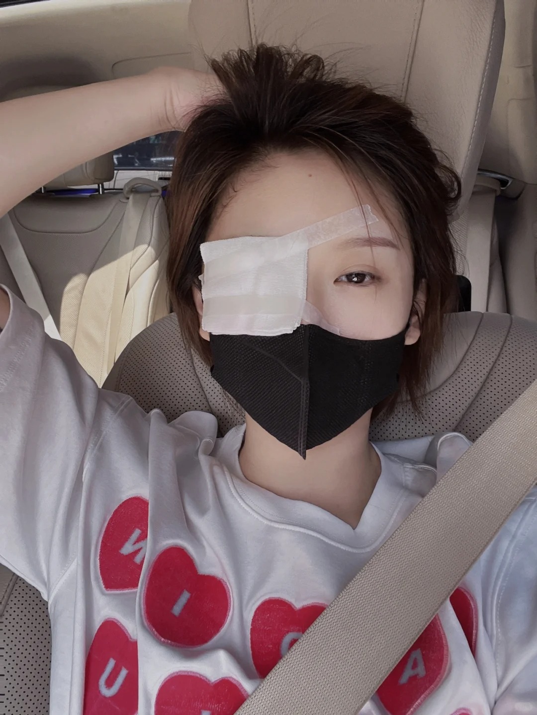 我是做完修补手术后一个月美女眼睛麦粒肿一只眼睛包纱布