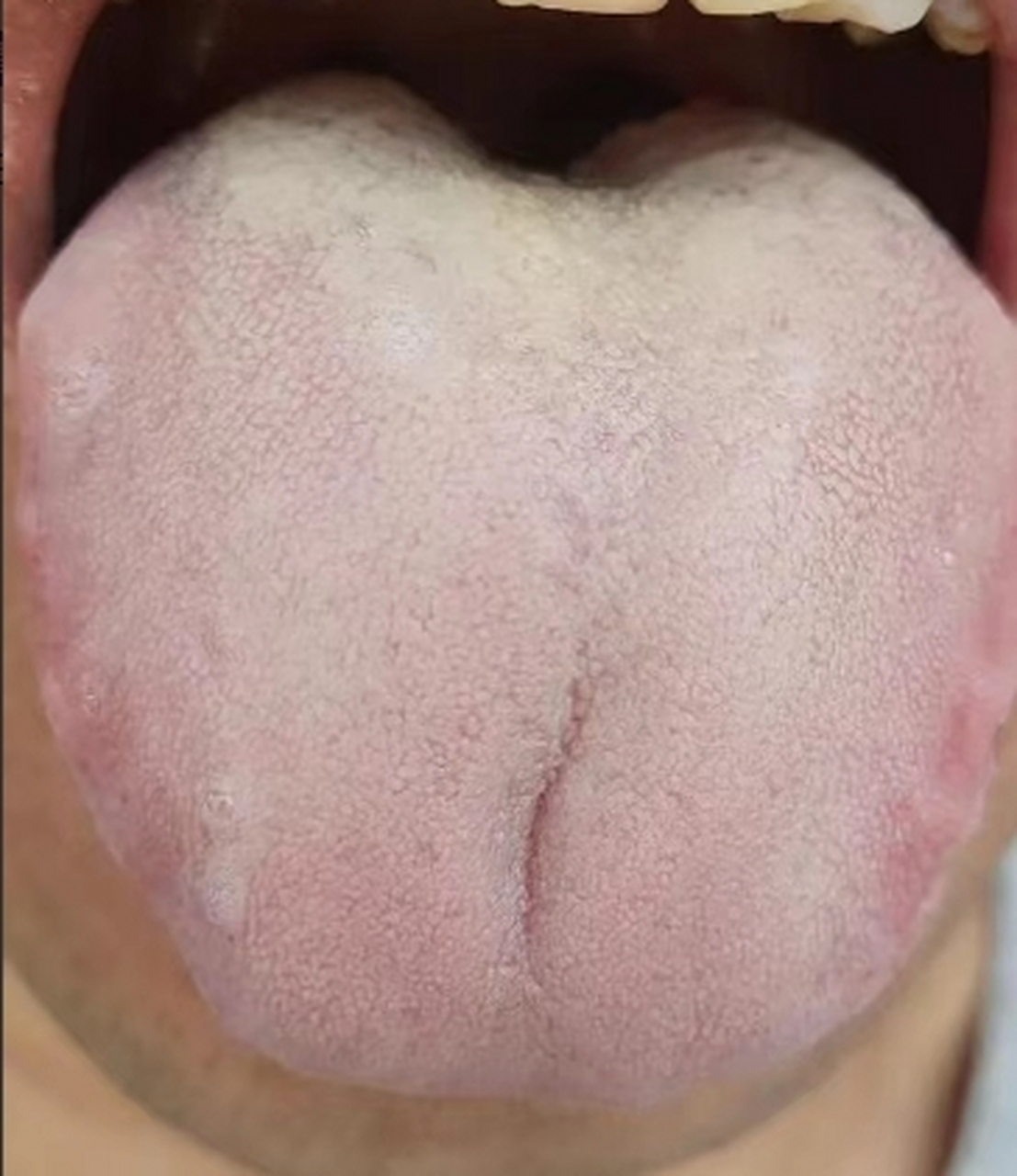 肾阳虚宗筋萎软,有湿热维持困难!这个舌苔,就是典型的脾肾两虚导致的!