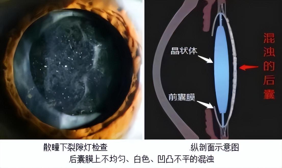 白内障裂隙灯图片