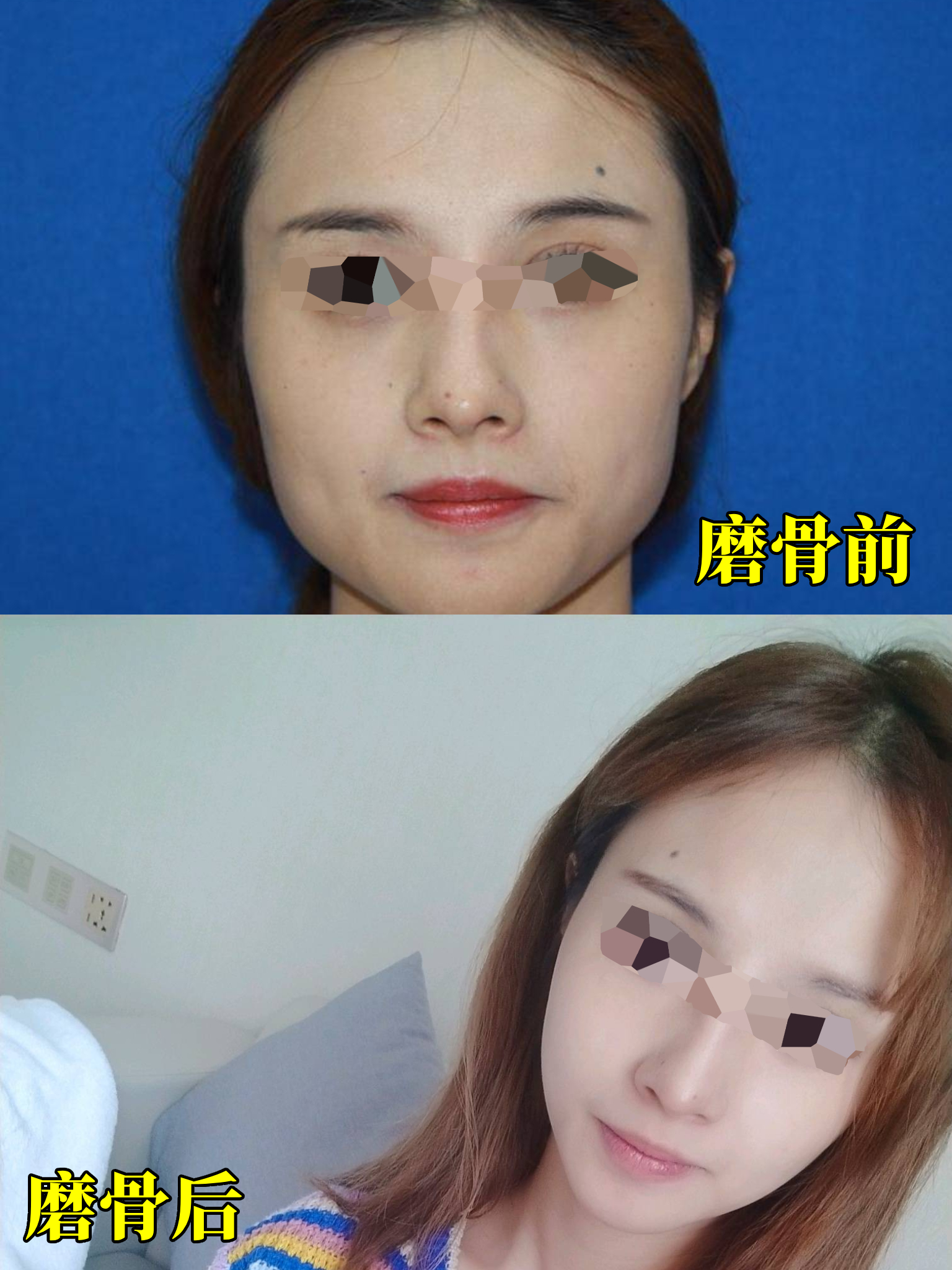 我的下颌骨很宽,从懂事以来磨骨就是我最大的梦想.