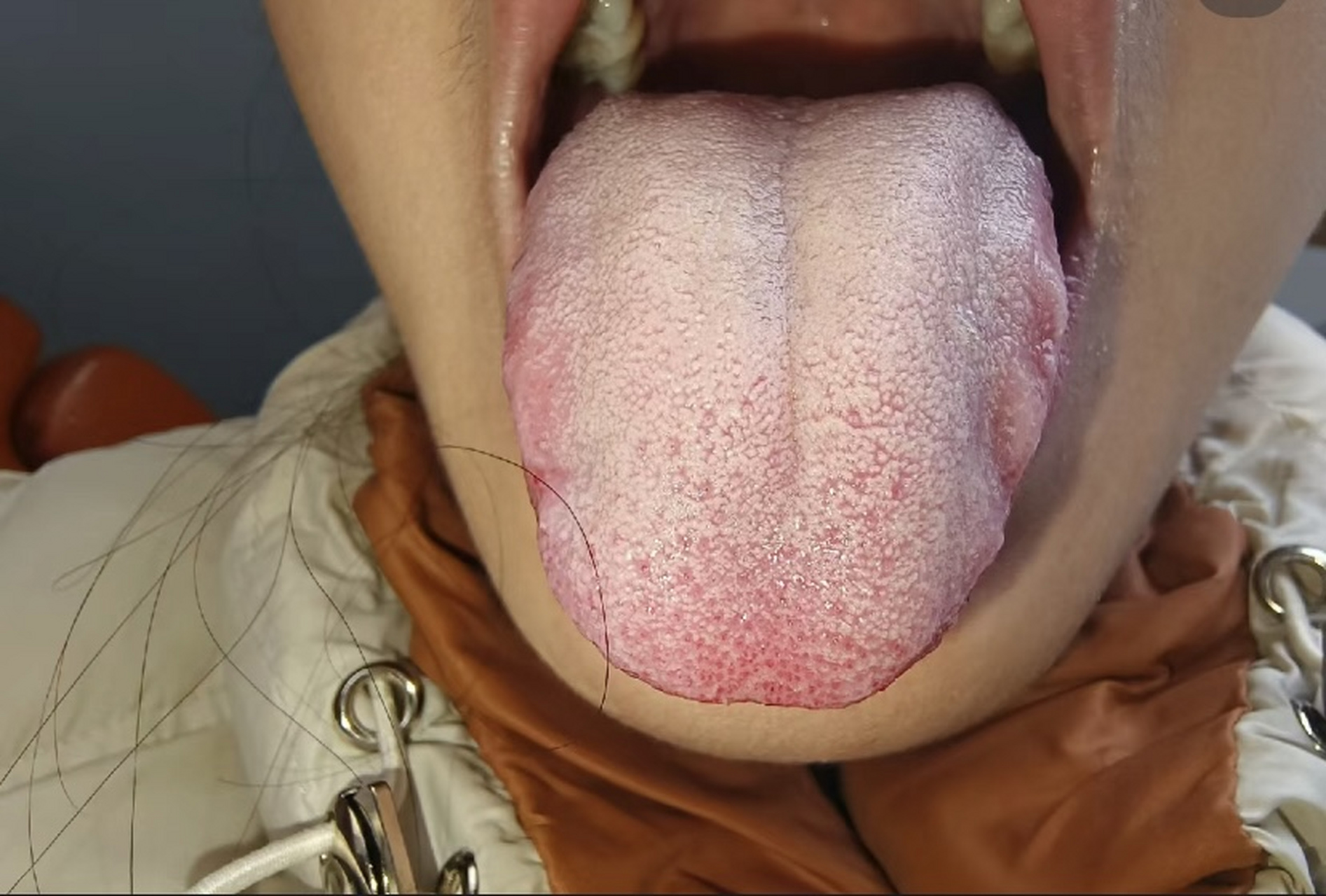 舌象特征:舌尖红,心火旺;舌边齿痕明显,脾虚湿重;舌苔白腻泛黄,脾胃