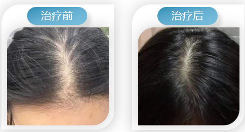 —永保健康·智慧生发毛囊克隆技术!