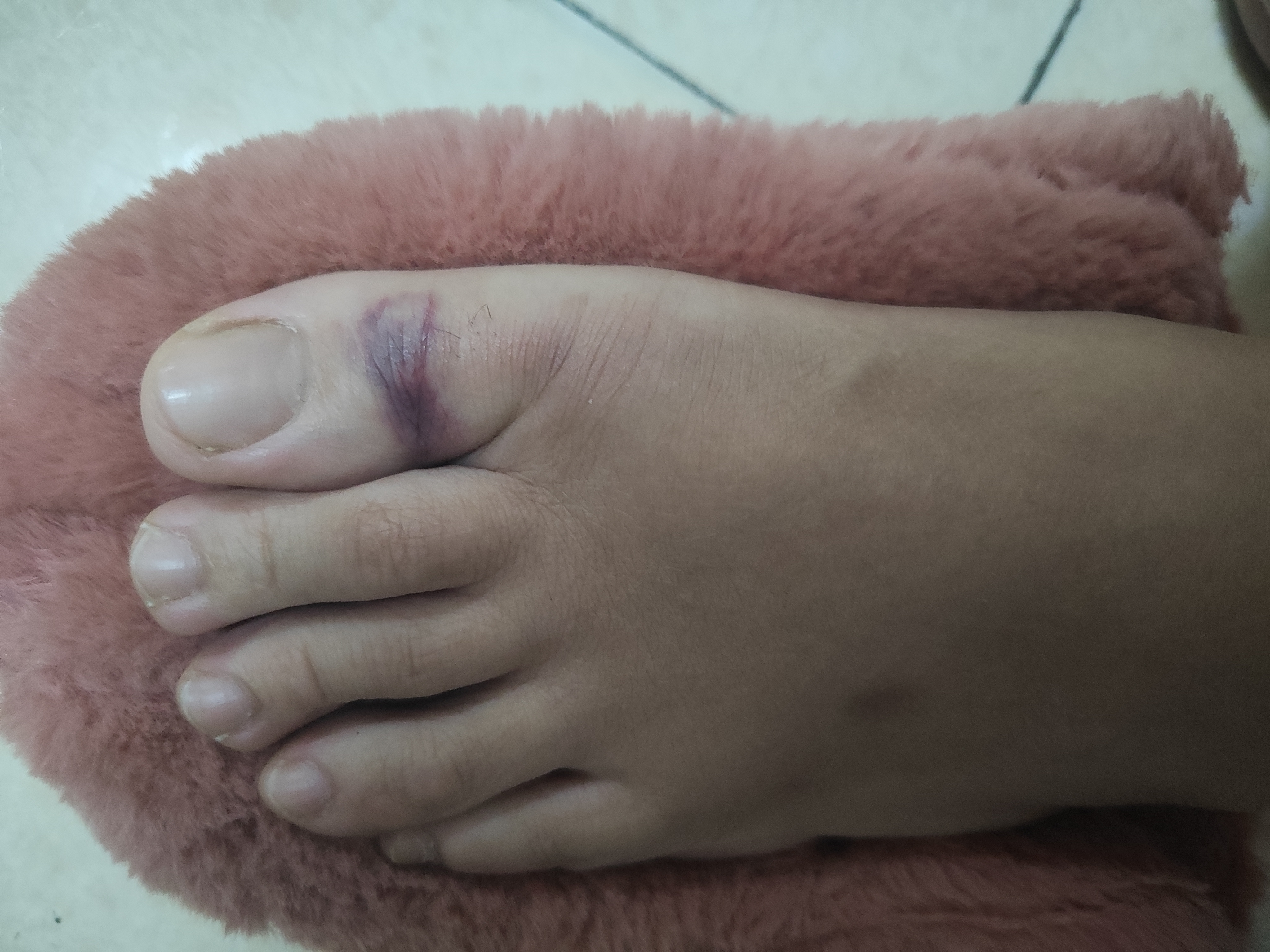 回家发现我的脚趾头变这色了,可能也许大概没骨折,只是软组织挫伤吧