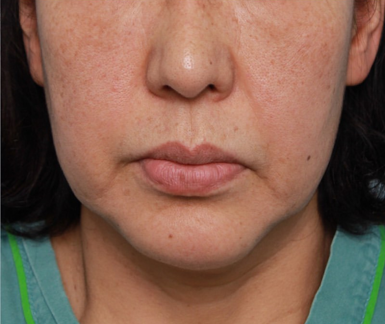 43岁吴女士面部松垮如60岁,做精准层析拉皮后,老公都兴奋了