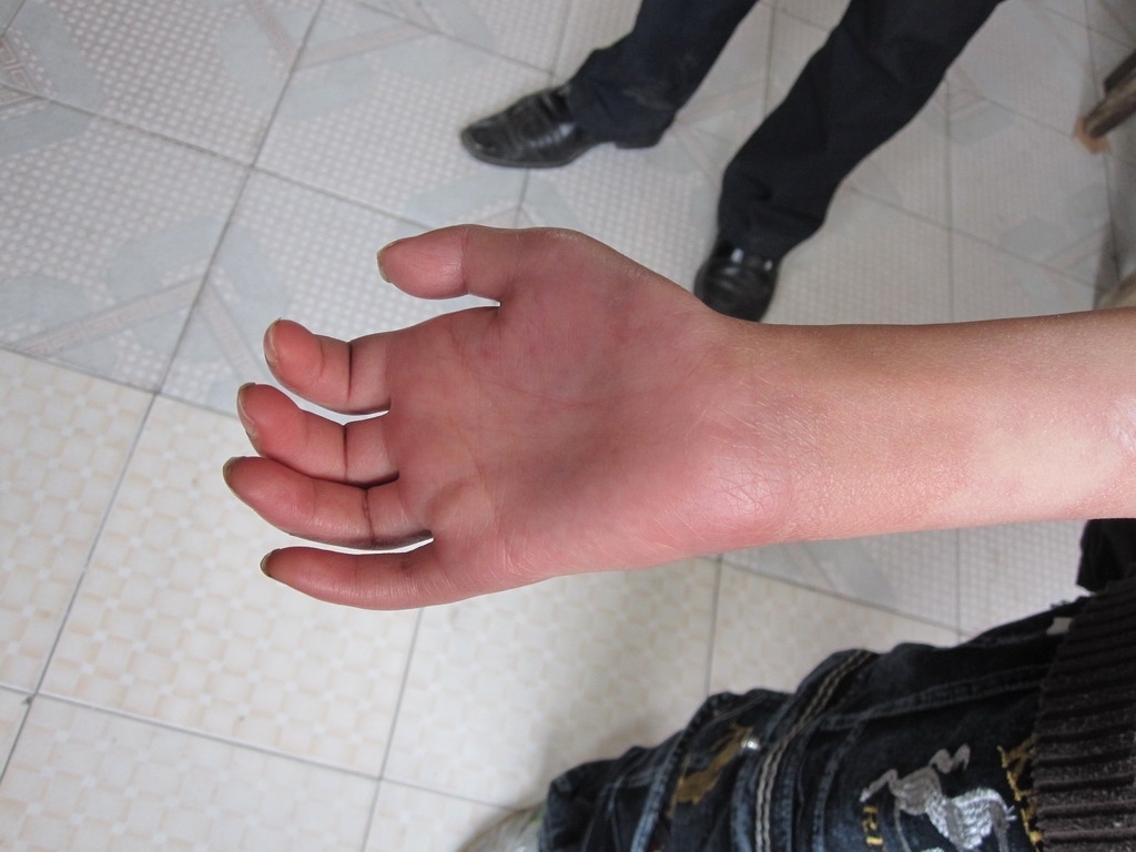 尺神经损伤需要多长时间恢复