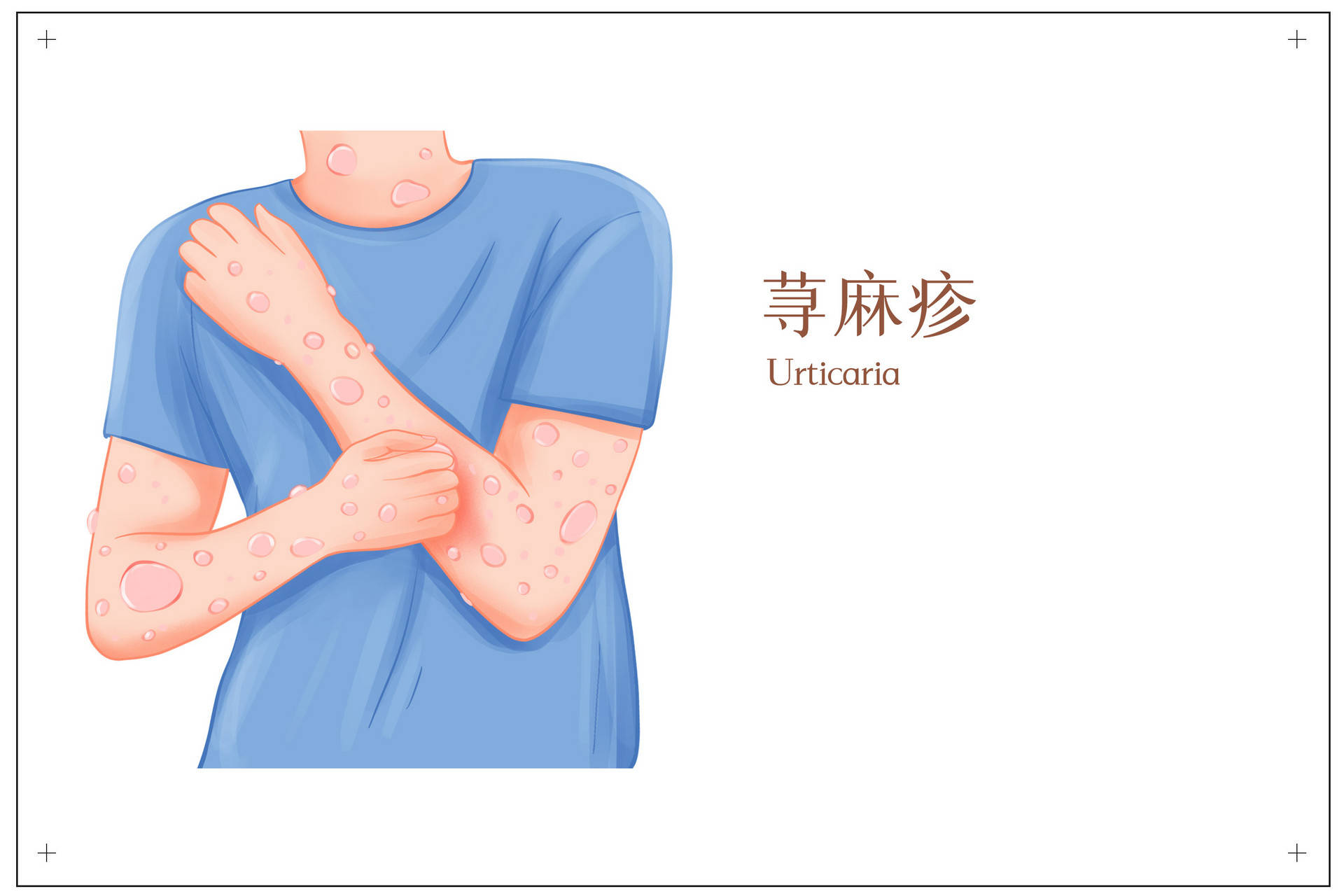 冬季冷风吹,身上起疹子痒怎么办?