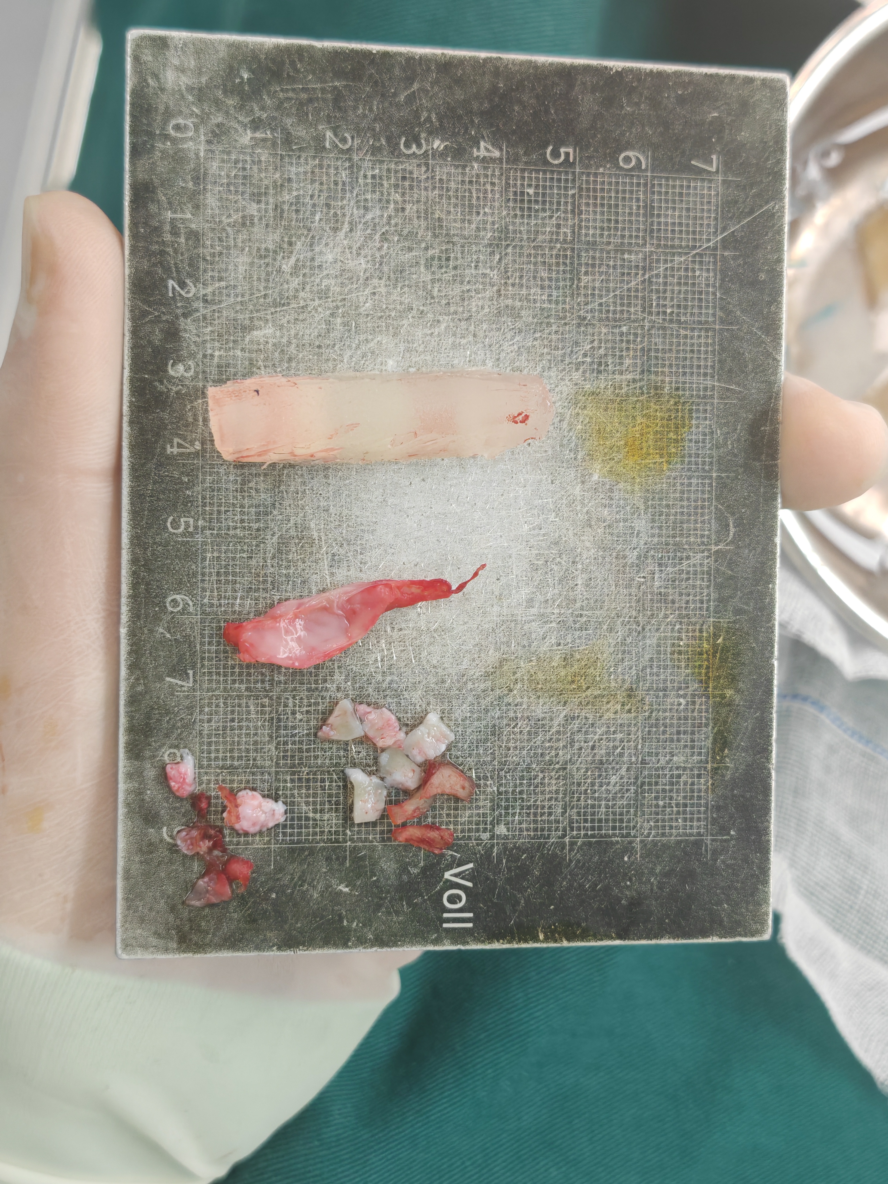 这些都是在鼻修复求美者的鼻内取出的,大家可以想象她修复前鼻子的