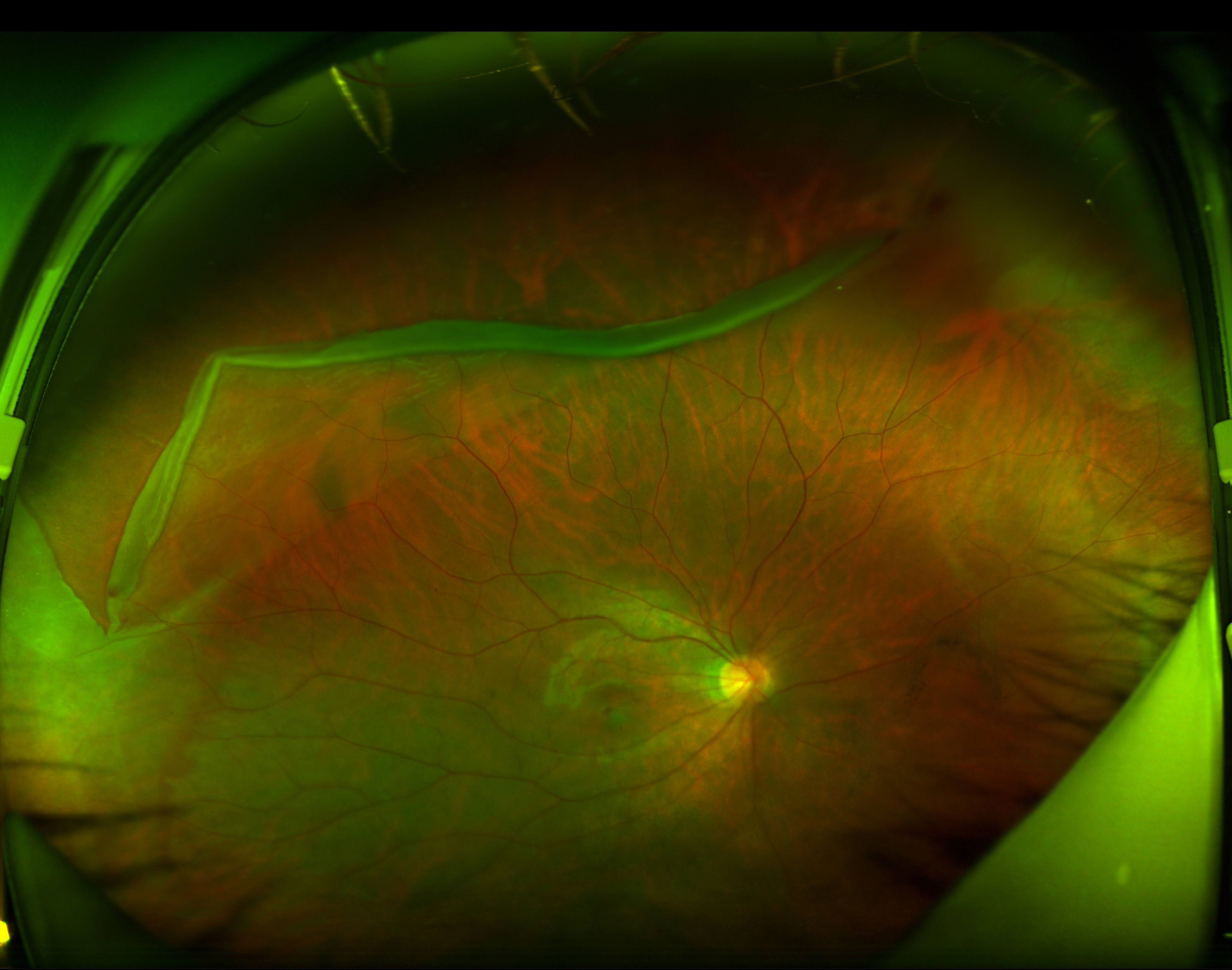 眼科常见病之视网膜脱离,您知道了吗?