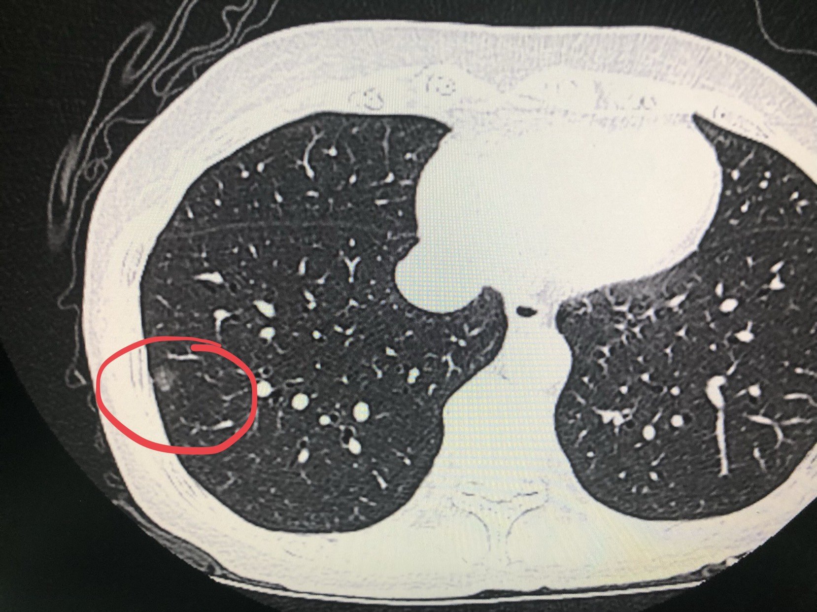 肺纤维灶磨玻璃结节图片