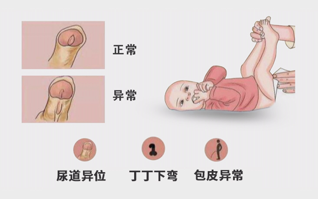 男性尿道口正常形态图片