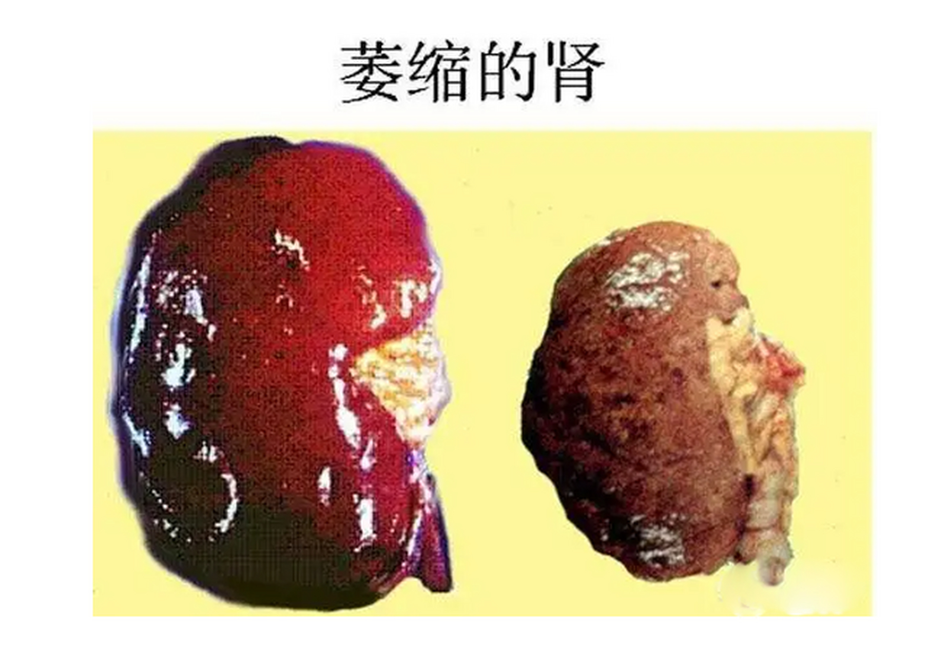 肾脏萎缩图片