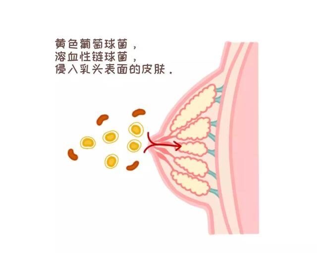 乳腺炎疾病:是乳房的急性化脓性感染,为细菌(金黄色葡萄菌等)经乳头