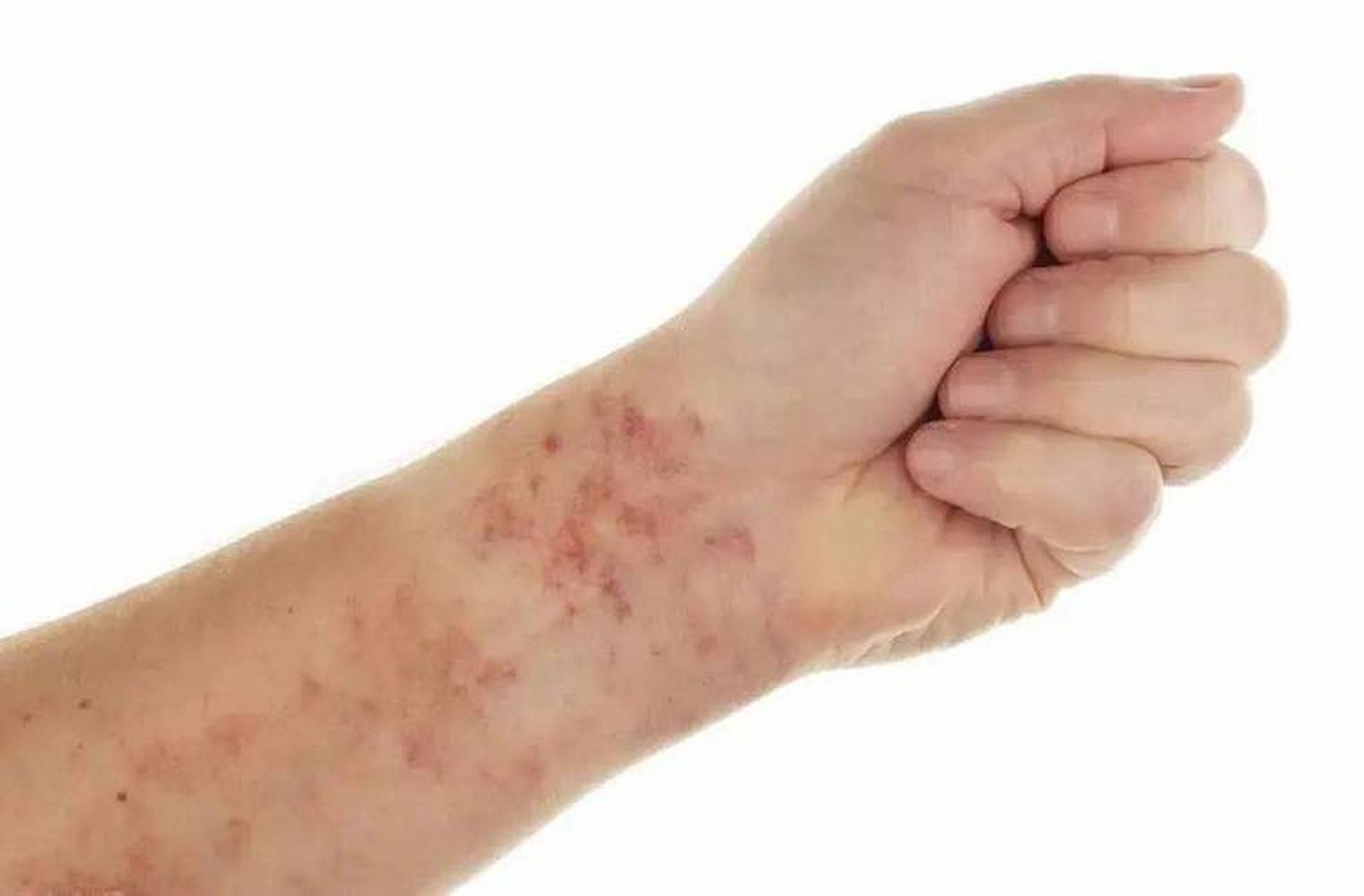 糖尿病患者,皮肤瘙痒要注意,特别是这三处!