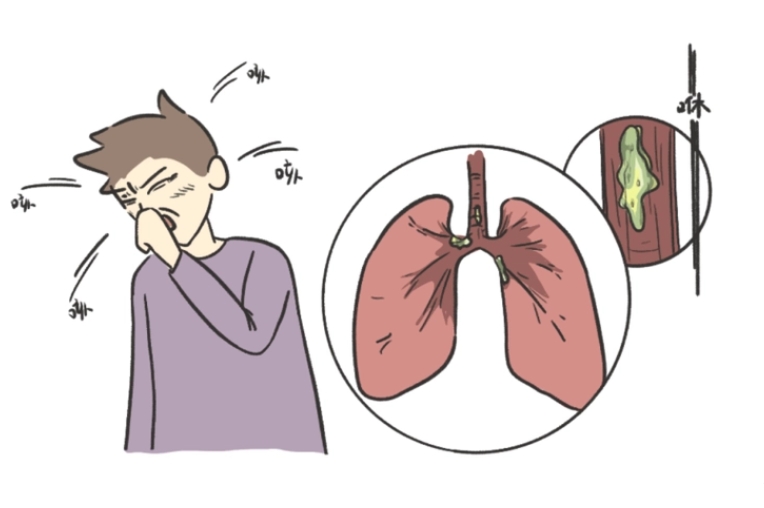 痰是肺的镜子,当出现这几种痰,可能是肺出现了问题!