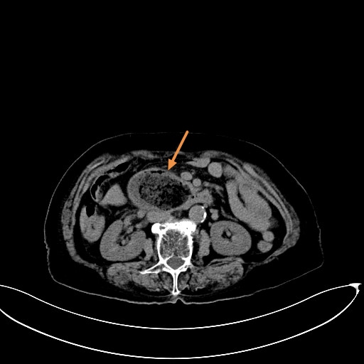 这是凌晨2点来的急诊病人, 老太太70多岁,剧烈腹痛,恶心, ct发现胃里 