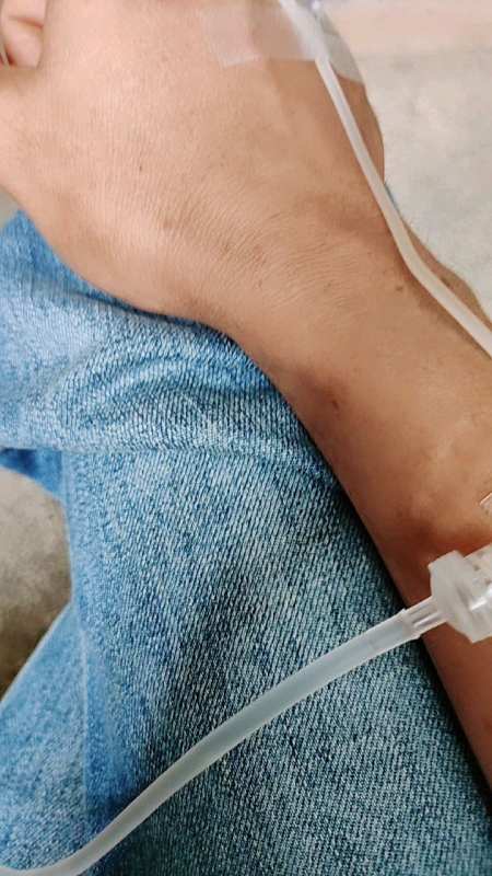 打消炎针第四天,手背上好几个针眼-度小视