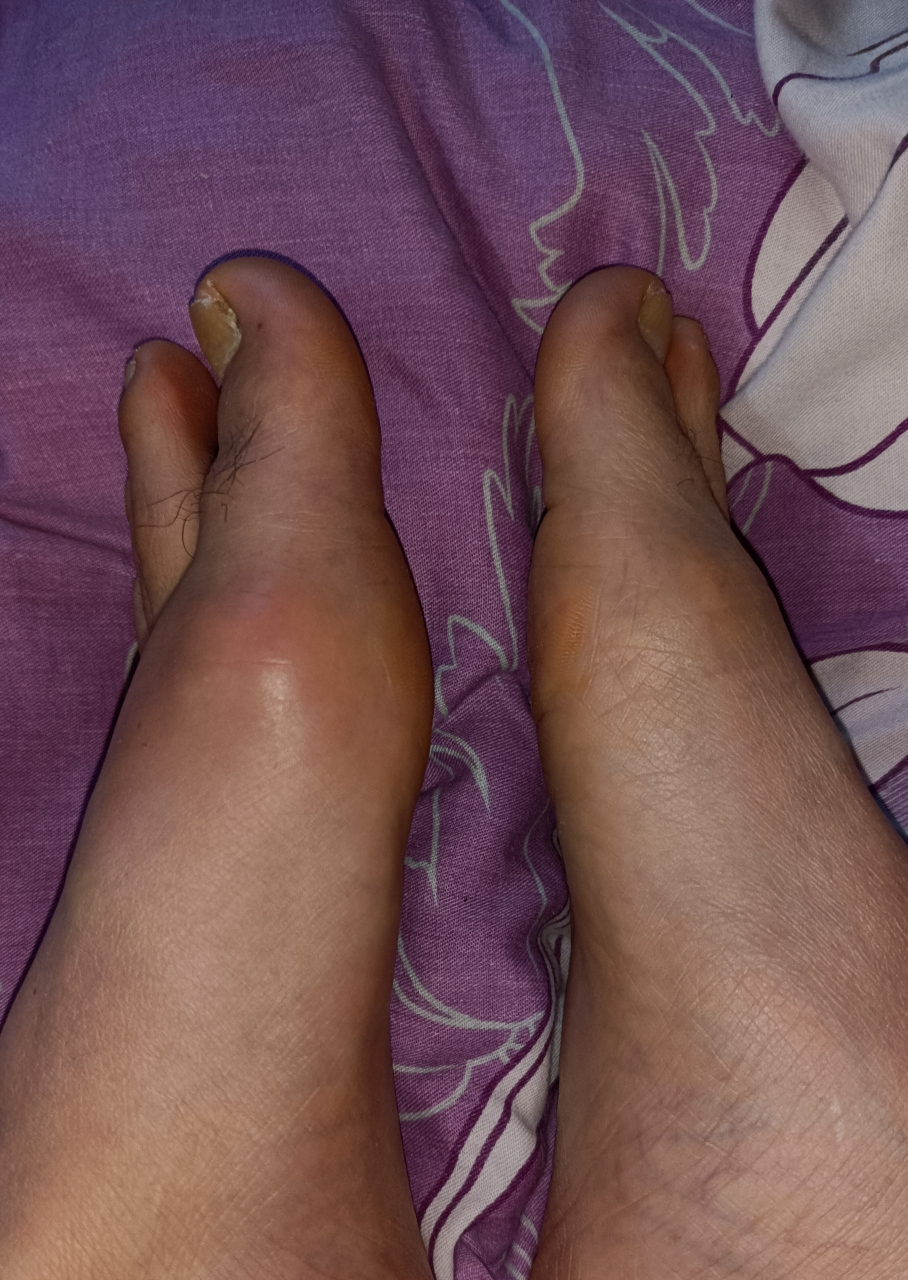 应该是痛风吧,表皮摸都摸不得,一碰就痛!