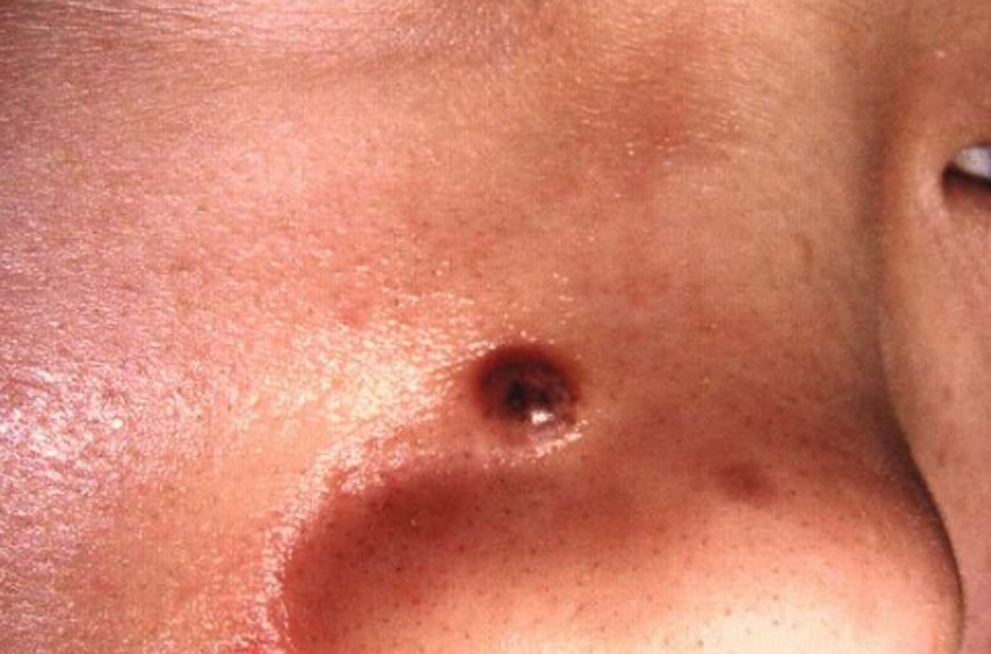 1,皮内痣 最常见于头颈部,直径从几毫米到几厘米,呈褐色