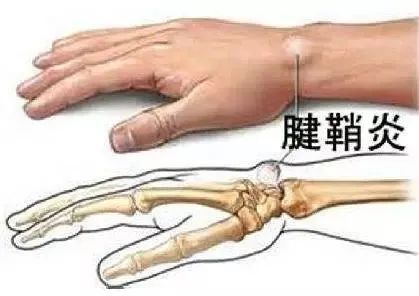 腱鞘炎易发生人群有哪些?你知道吗? 1