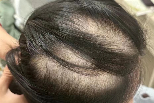 揭秘秃顶女孩的秀发护理法宝!轻松省下一大笔护理费用!