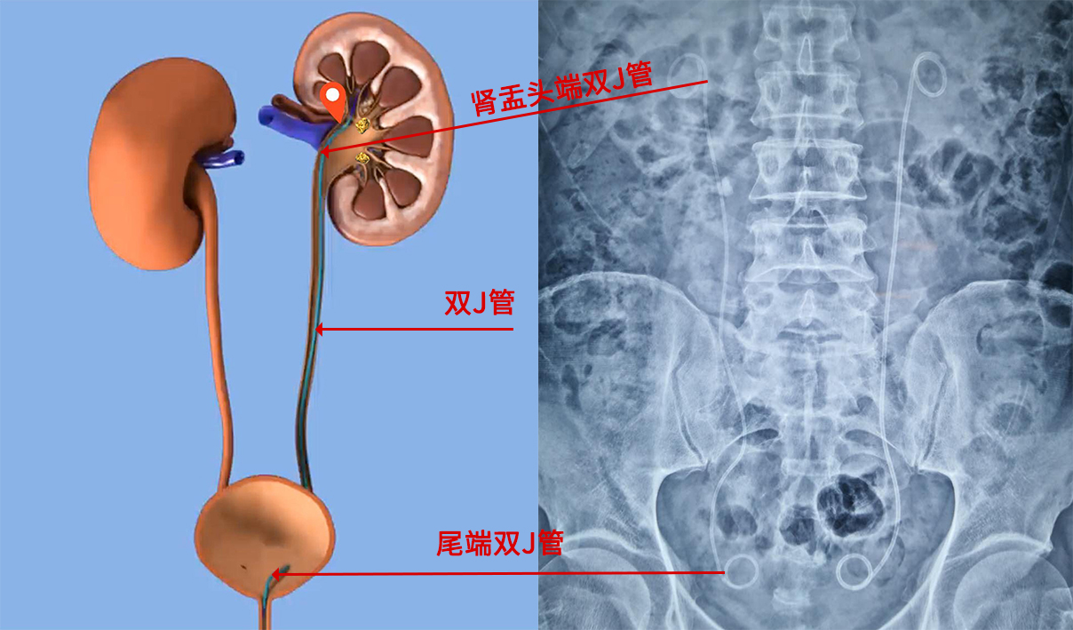 双j管位置图图片