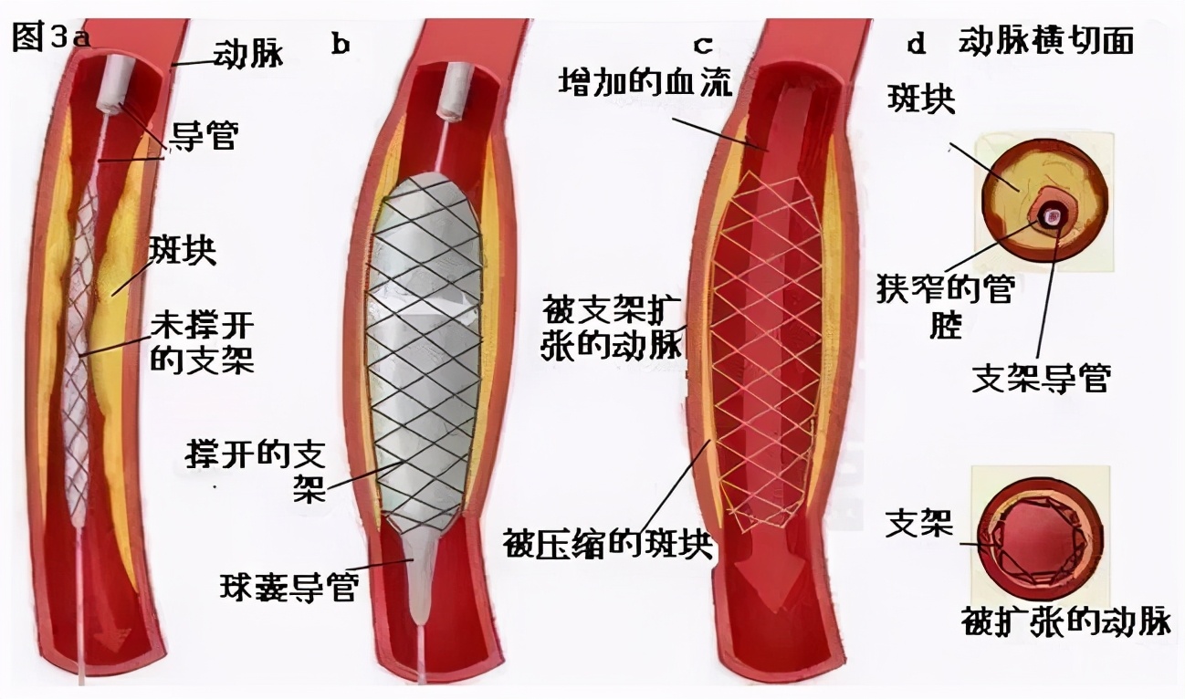 血管支架过程示意图图片