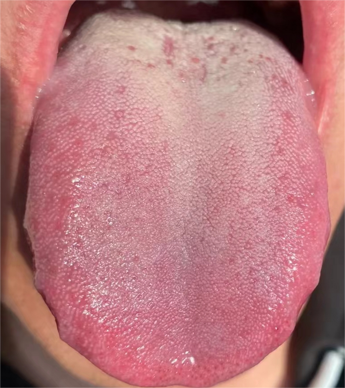 这个舌象,典型的上热下寒,想法多,但身体跟不上