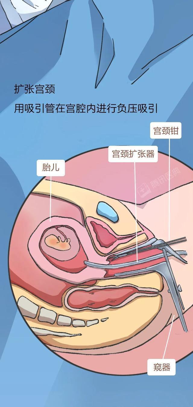 你知道人流手术过程多难受吗?漫画揭晓