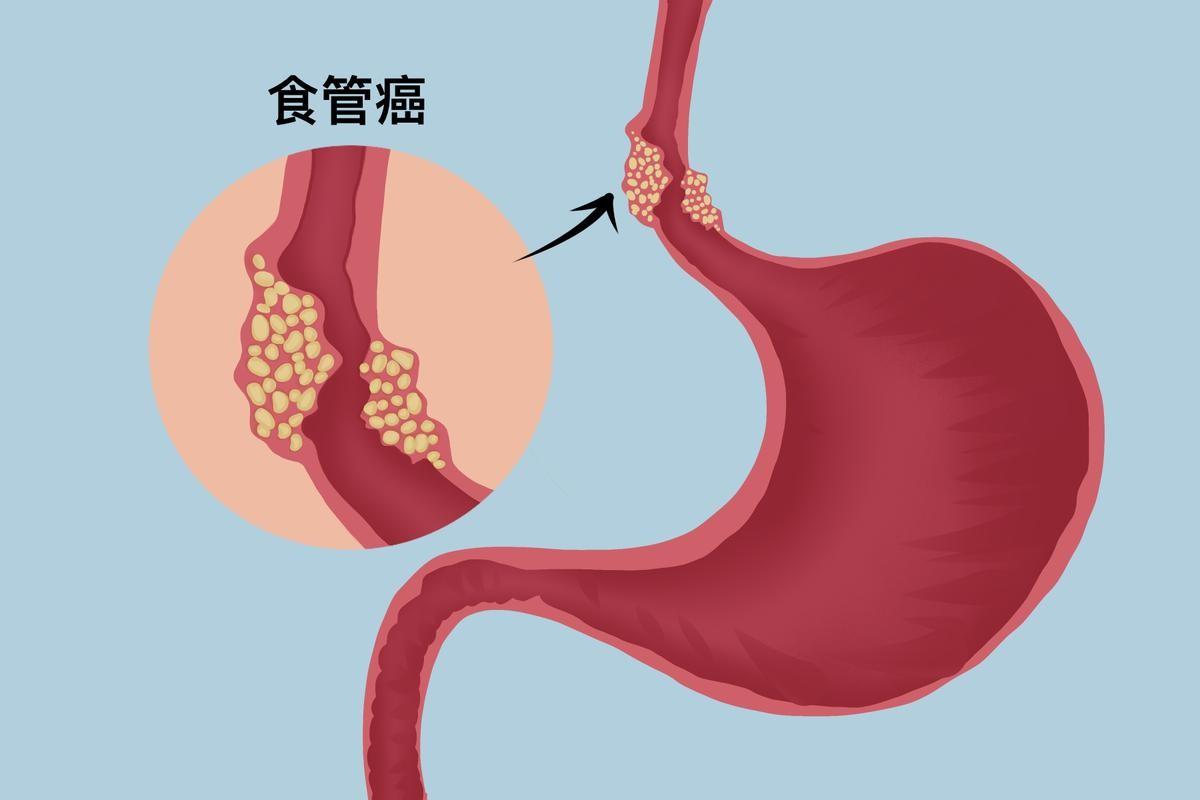 女子心口刺痛診斷食管癌術後複查懷疑膽囊癌一切決定交給丈夫