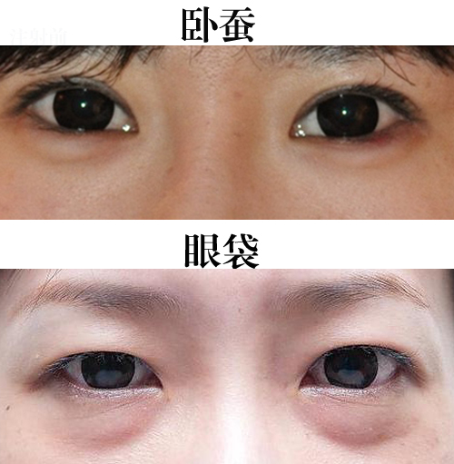 与眼睛连得较紧密;眼袋的位置要更加靠下,与鼻梁中下部水平,离眼睛较