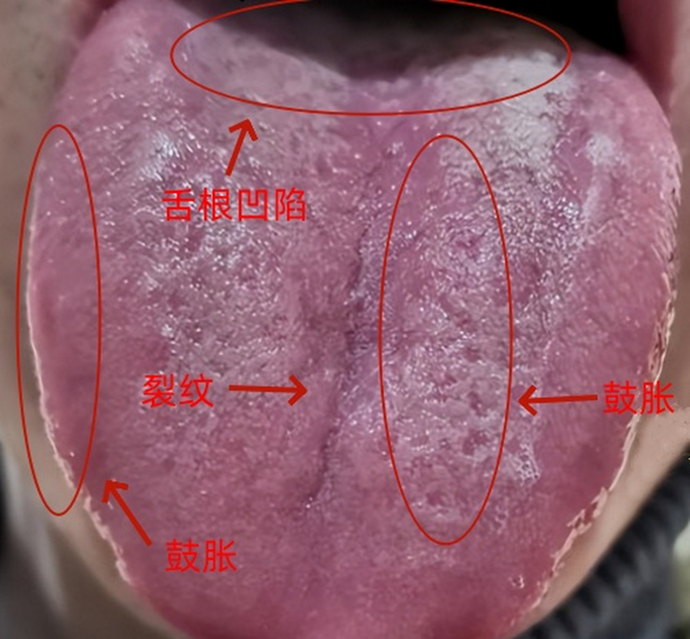 剥落苔,舌质暗红,属于气阴两伤导致的功能问题,不要只吃六味地黄丸!
