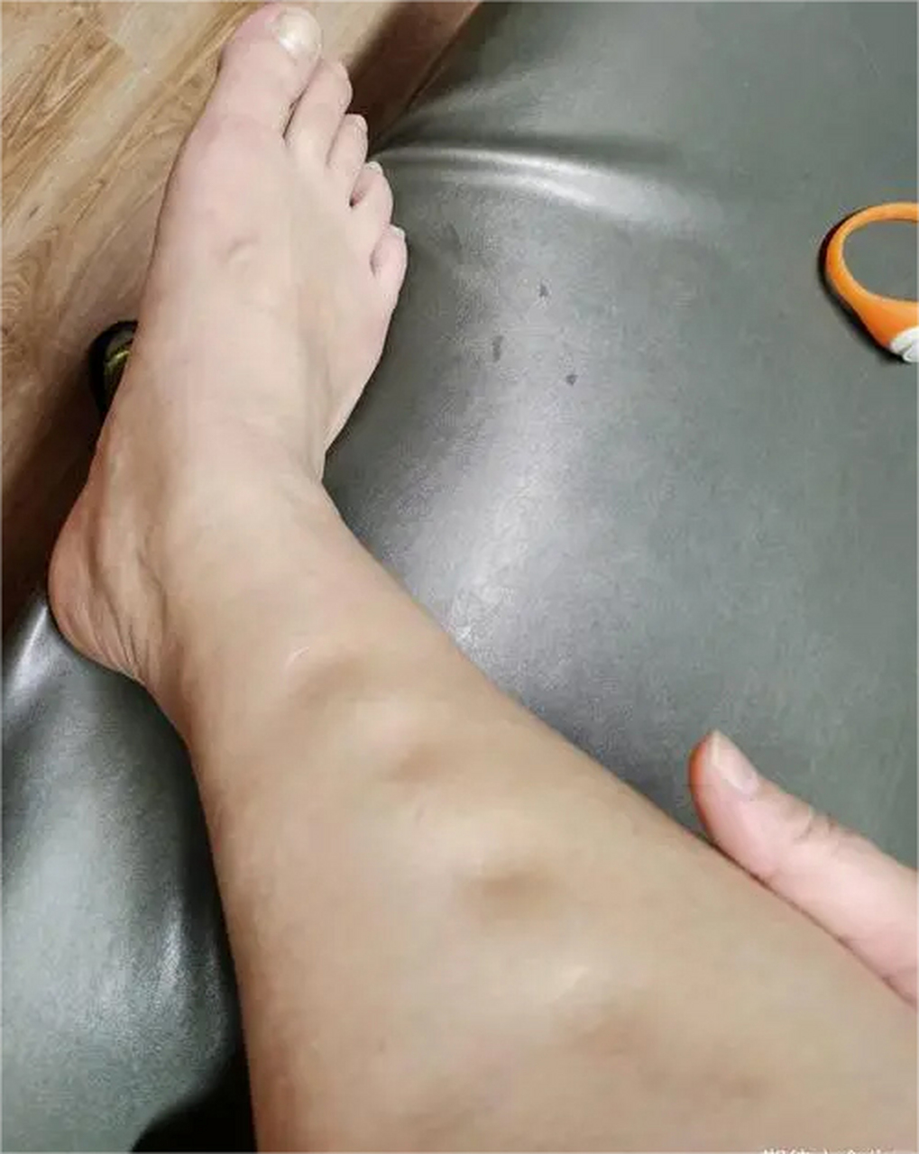 45岁女子尿蛋白3 ,坚持吃厄贝沙坦,却得了肾衰竭,医生:犯了3错