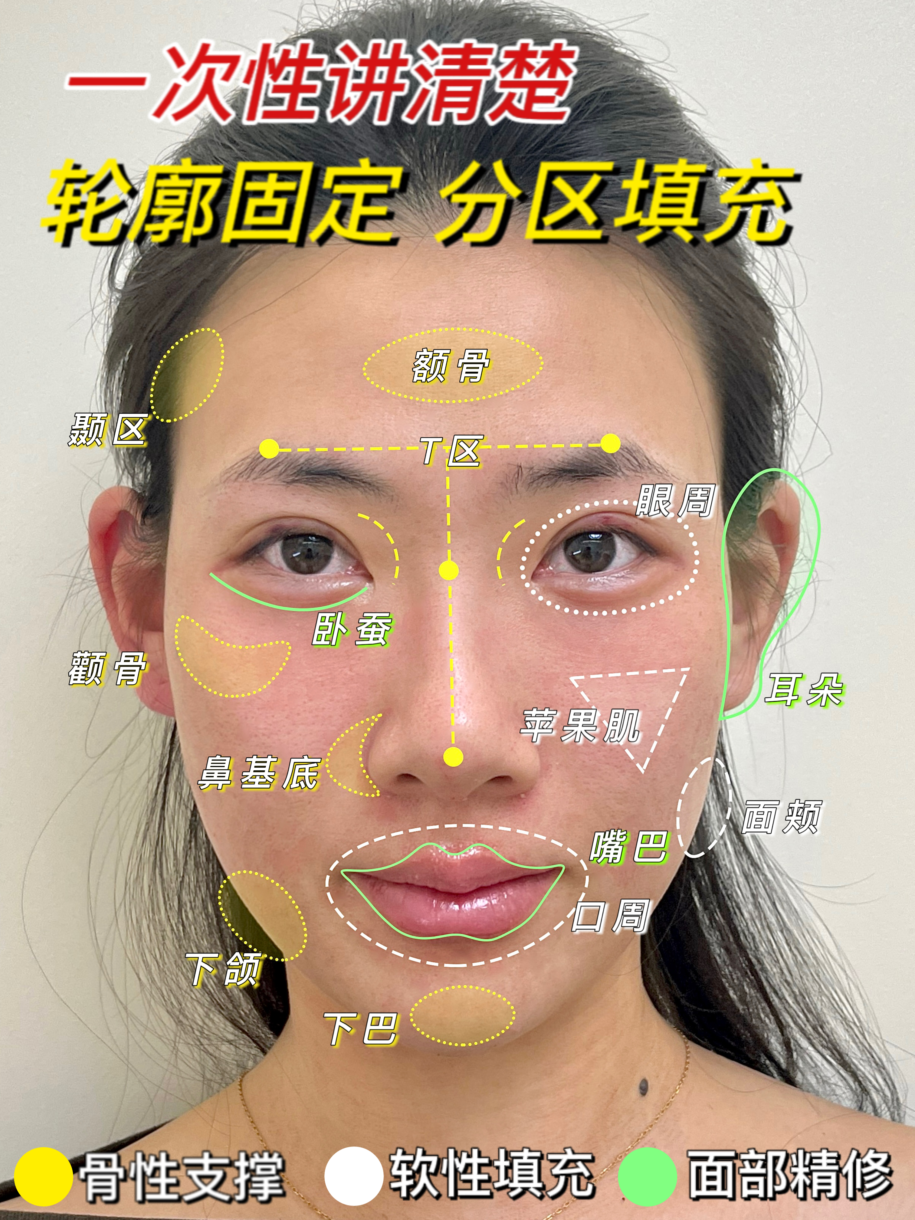 面部轮廓固定区域一般分成:骨性支撑区,软性填充,区面部精修区