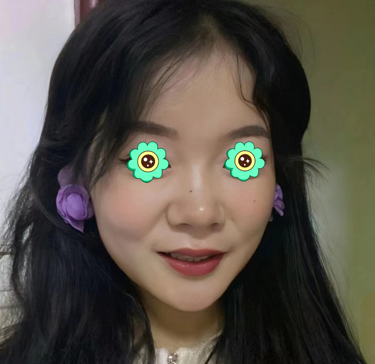 做了玻尿酸填充法令纹,真的感觉自己又回到了二十几岁的时候  我这