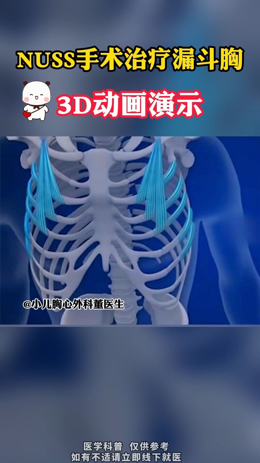 nuss手术治疗漏斗胸,3d动画演示!