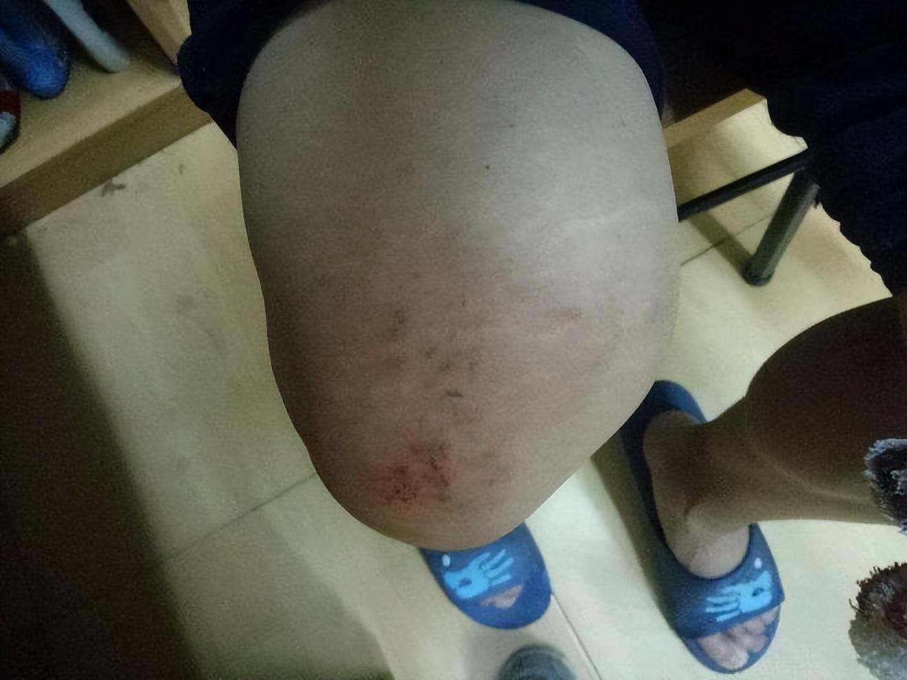 24岁研究生膝盖扭伤两个月后离世器官捐给多人遗言令人泪目