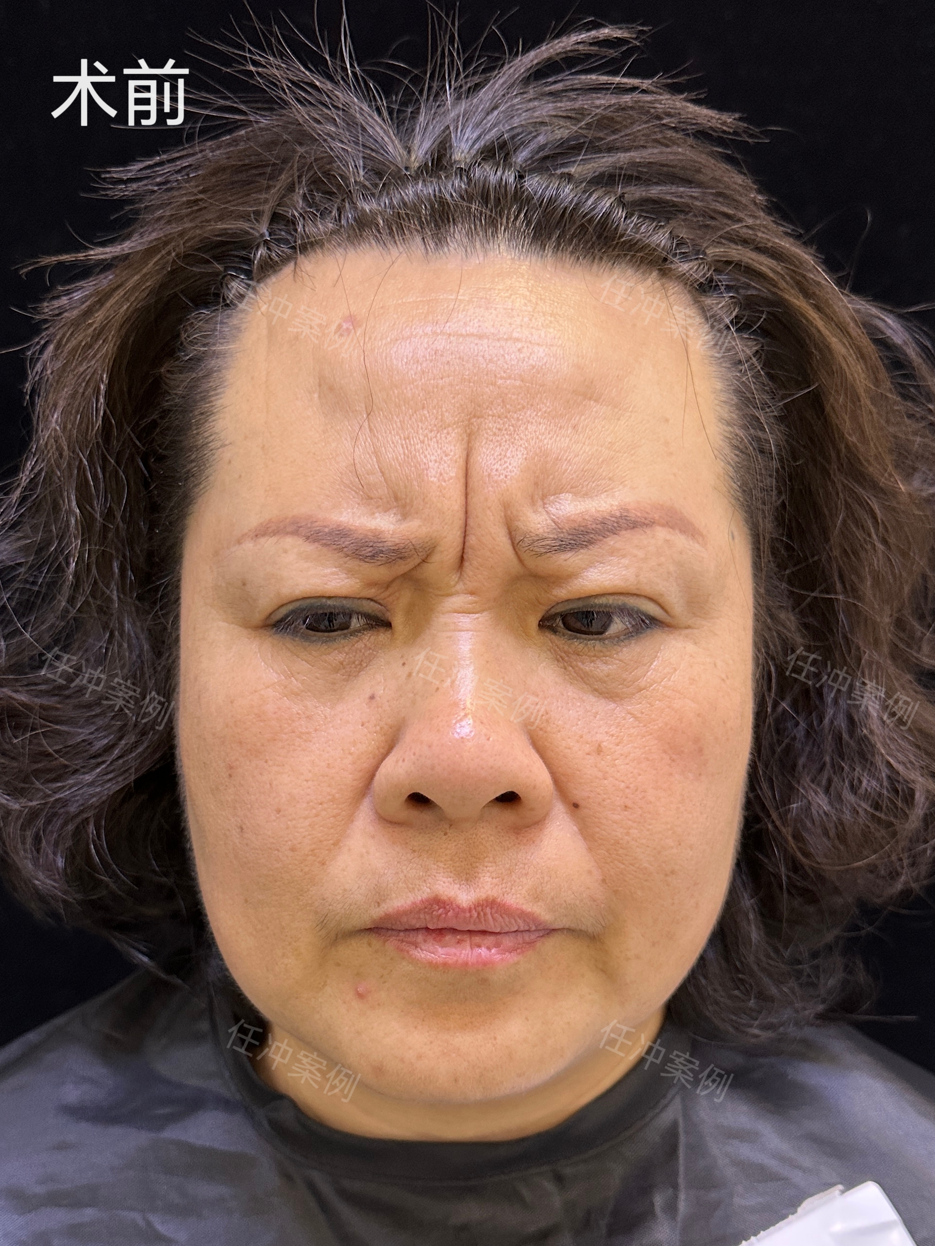 那么发达的医学,你想改善小小的一道眉间纹,但是跑遍出名的医院,那么