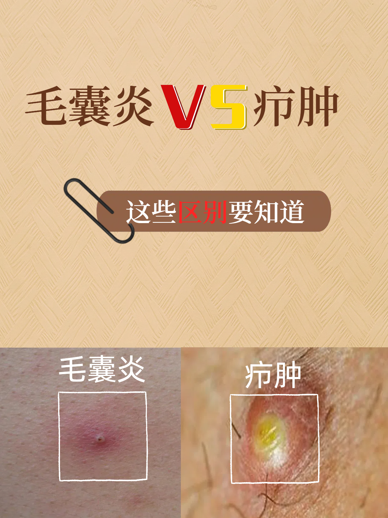 毛囊炎vs疖肿,这些区别要知道03.@周汛医生的动态