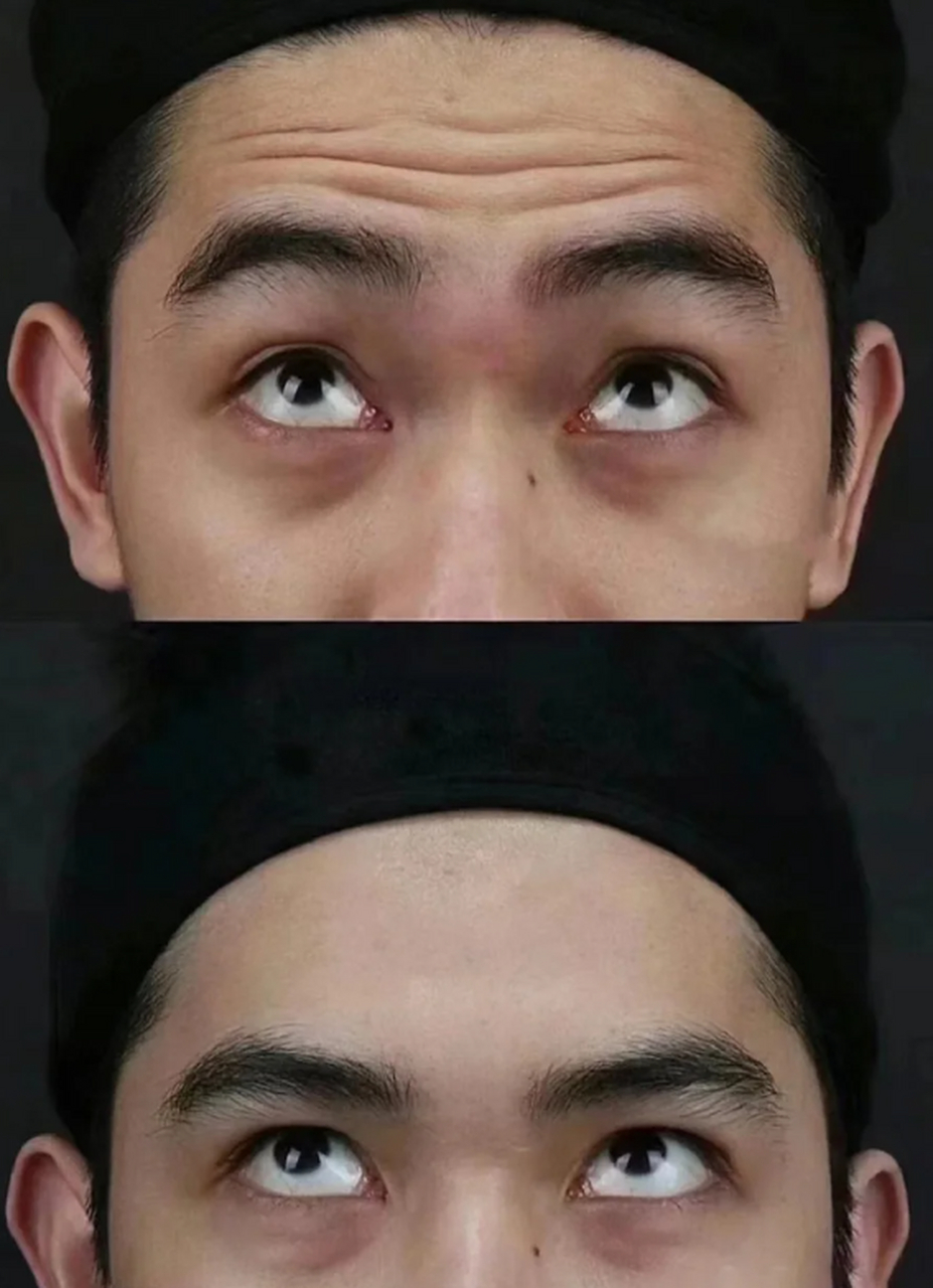 抬头纹与上睑下垂的关系 这位患者是个男孩子,睁眼废力,手术目的是