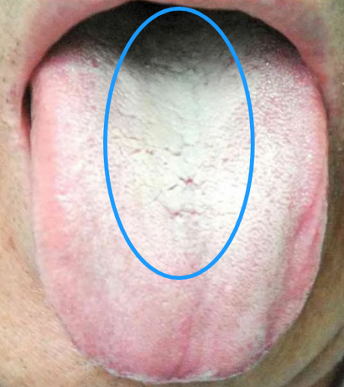 男科功能好不好,看看舌根就知道!