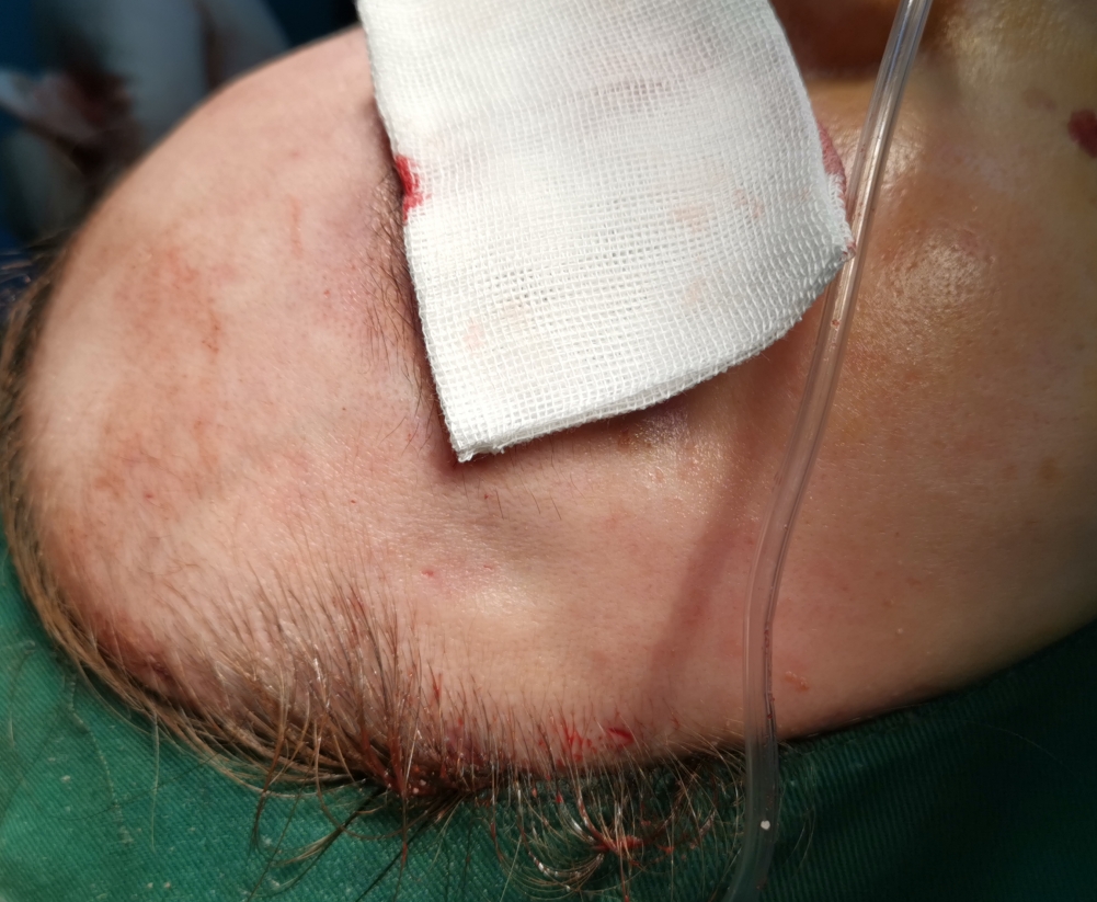 80后美女太阳穴打了奥美定,流到上眼皮,变成"肿眼泡"