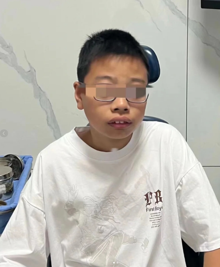 爸妈很后悔-12岁儿子腺样体面容  前段时间来了一位12岁腺样体面容小