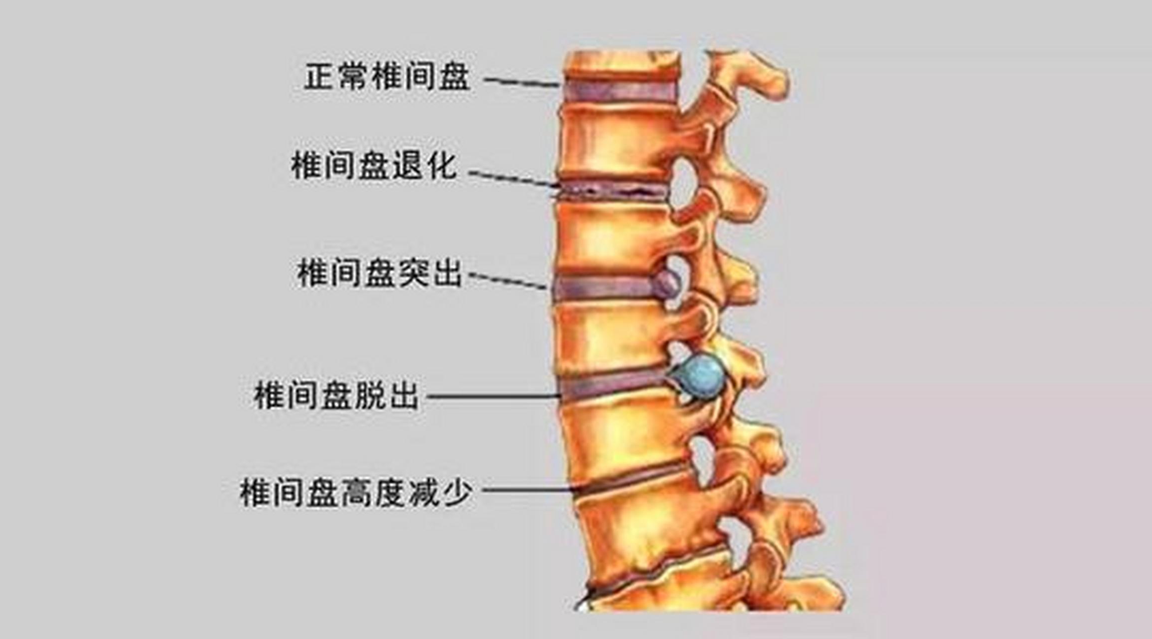 腰椎滑脱图片示意图图片