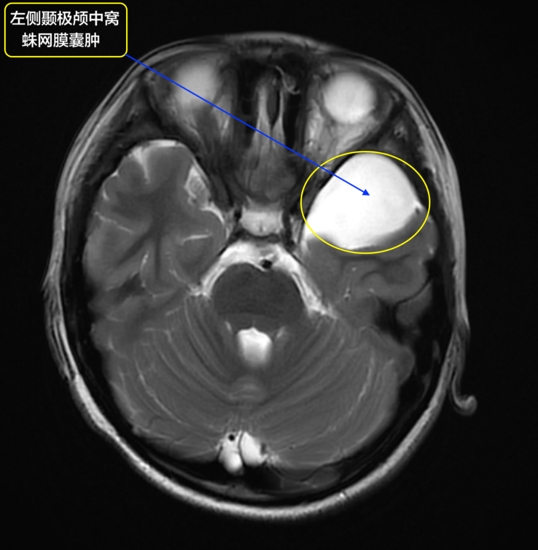 什么是颅内蛛网膜囊肿?