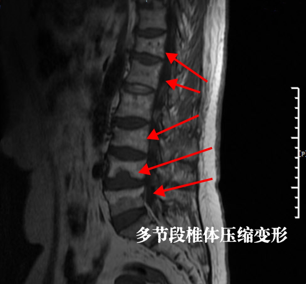 腰椎核磁共振图片正常脊椎骨ct影像腰椎正常ct影像图胸椎楔形图片无