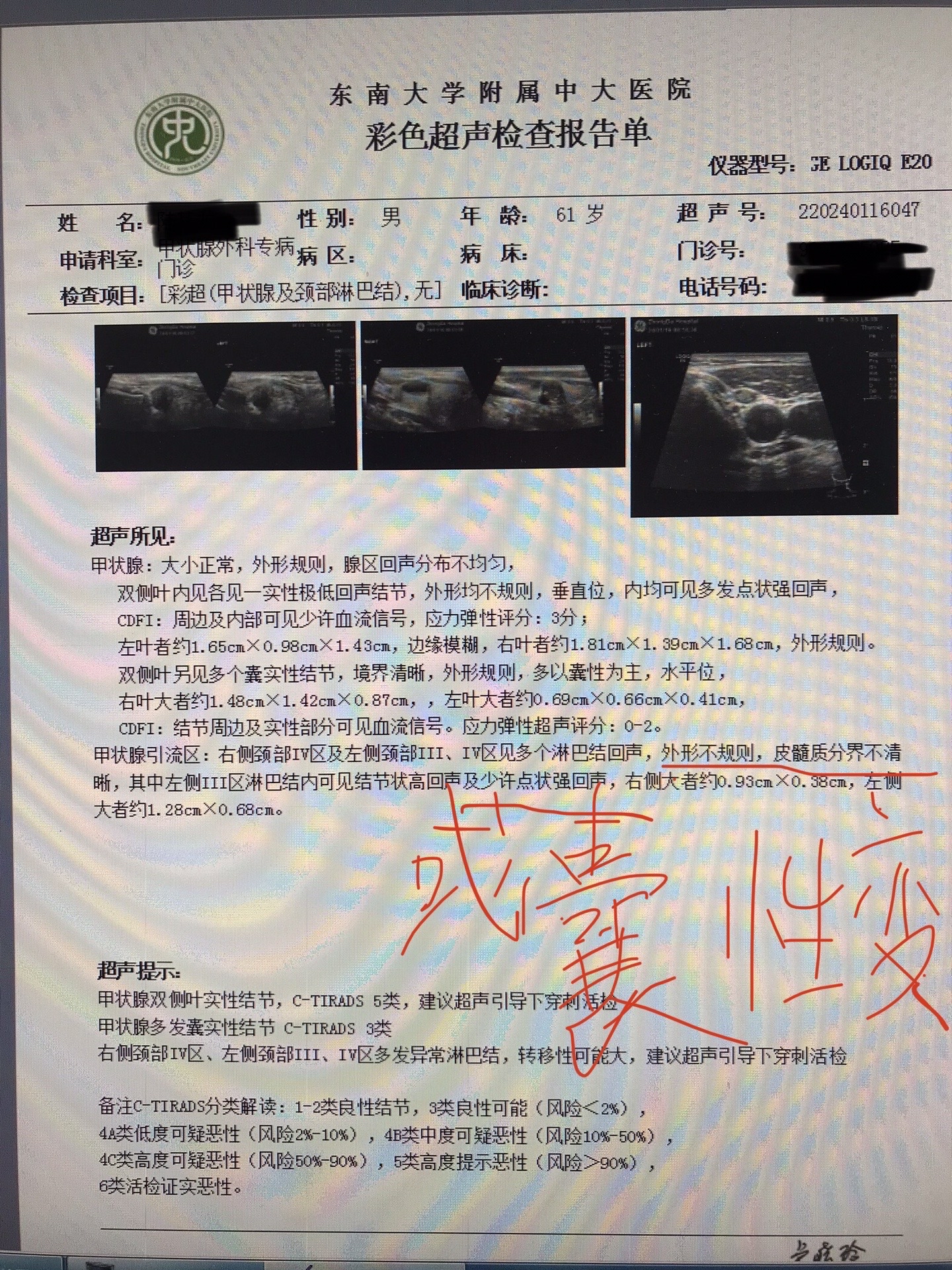 甲状腺癌淋巴转移