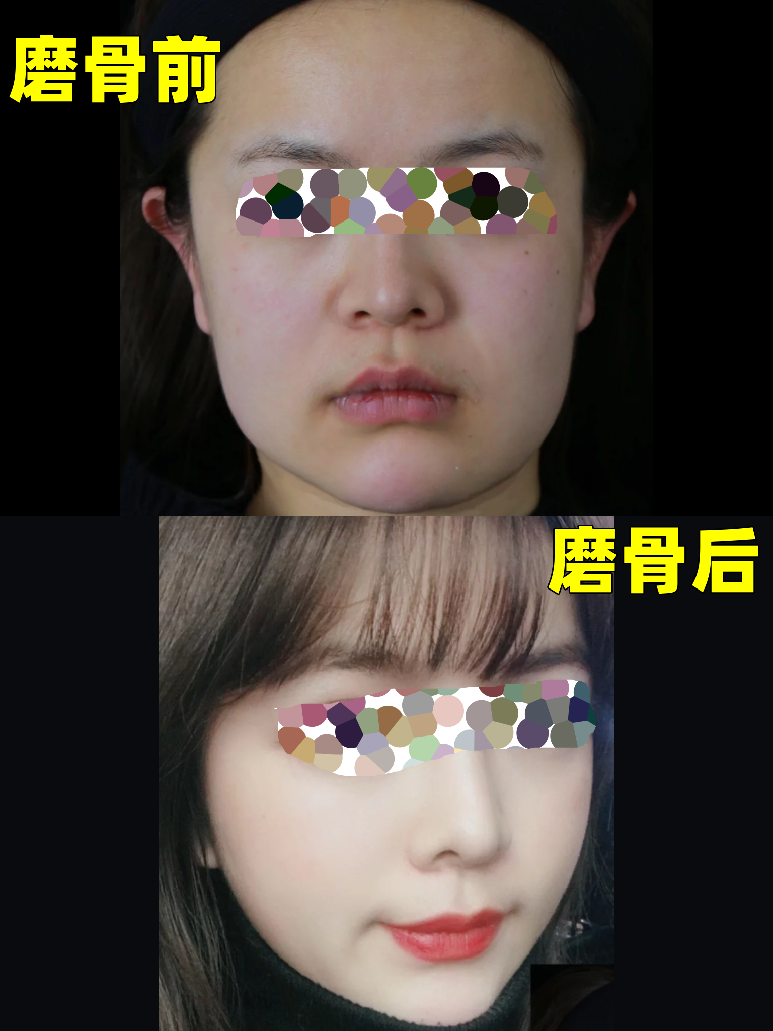 经过痛苦挣扎,还是决定去做下颌角磨骨了