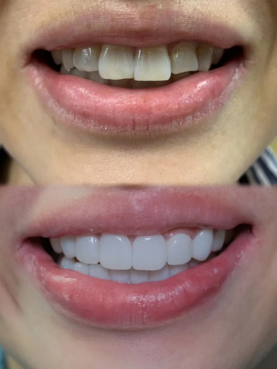 一位牙友的蓝瓷牙贴面对比图,被牙齿困扰的朋友是不是突然发现了新