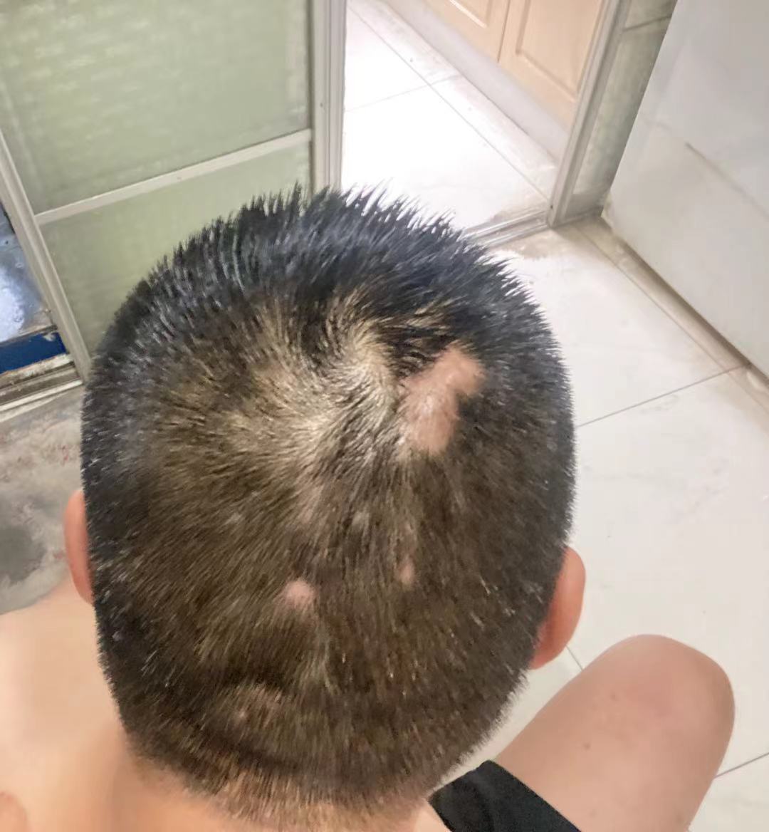 头上鼓起的这种大脓包,软软的,什么时候能消下去?